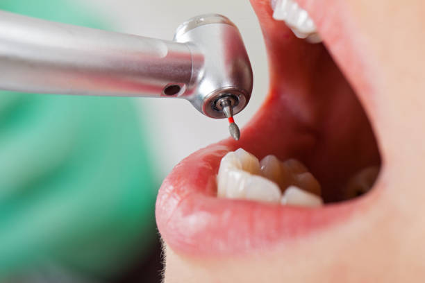 Best Emergency Wisdom Teeth Removal in Aberdeen, MS